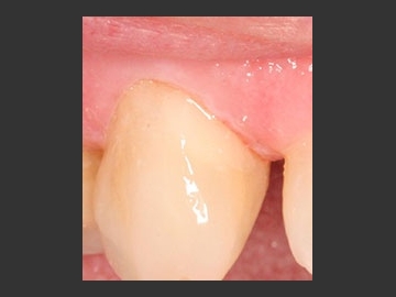 Bonding: A quick filling can also repair decay at the gumline! 