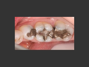 Cerec - Onlays, crowns:  The above CEREC porcelain restoration procedures took approximately 80 minutes from start to finish, and there were no follow-up visits!  The material used has similar physical characteristics to enamel, the hard outer shell of your teeth ... 